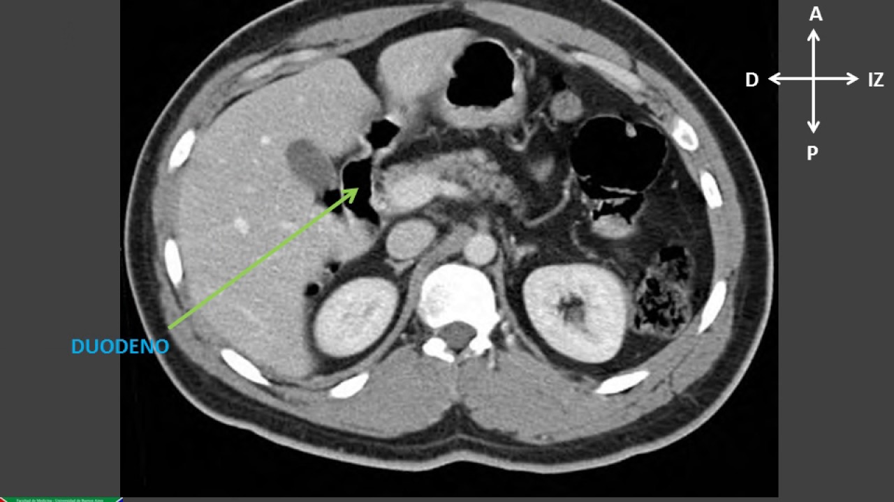 Anatomía por Imágenes del abdomen en TC