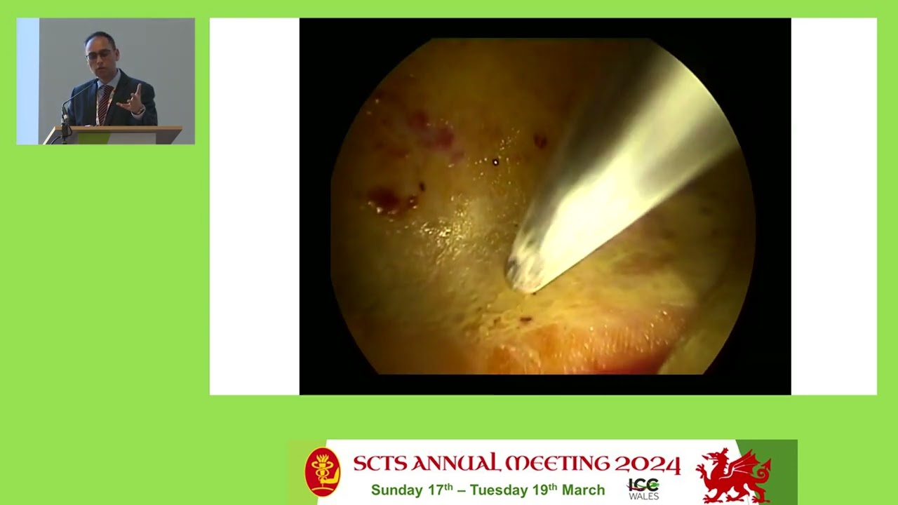 Najib Rahman - Evolving management of malignant pleural effusions