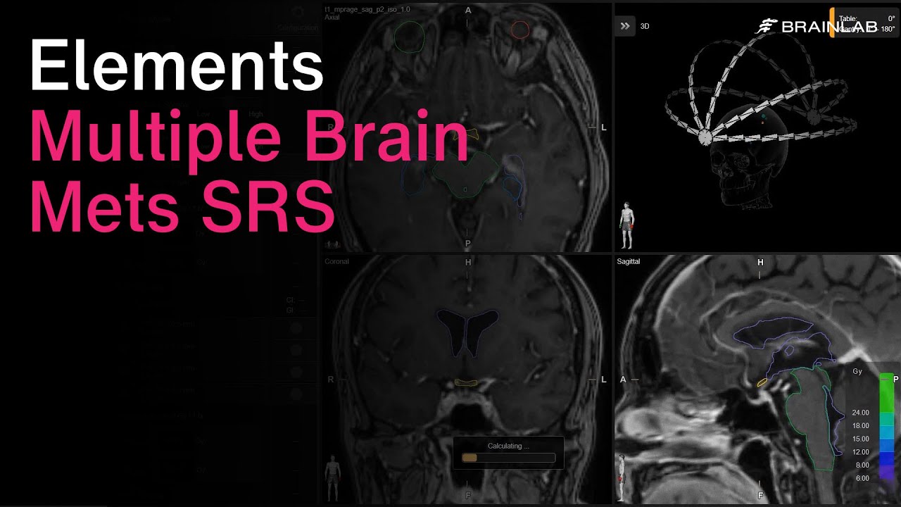 Radiosurgery Solution for Treatment of Multiple Brain Metastases - Multiple Brain Mets SRS