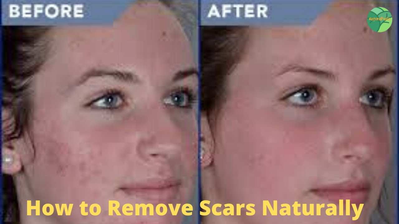 How to Remove Scars Naturally