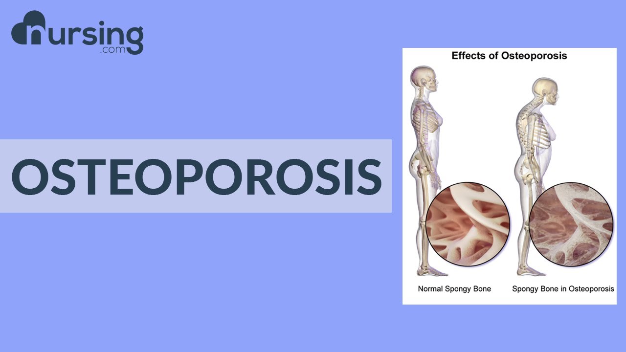 Osteoporosis...Everything you NEED to know, no fluff (Nursing School Lessons)