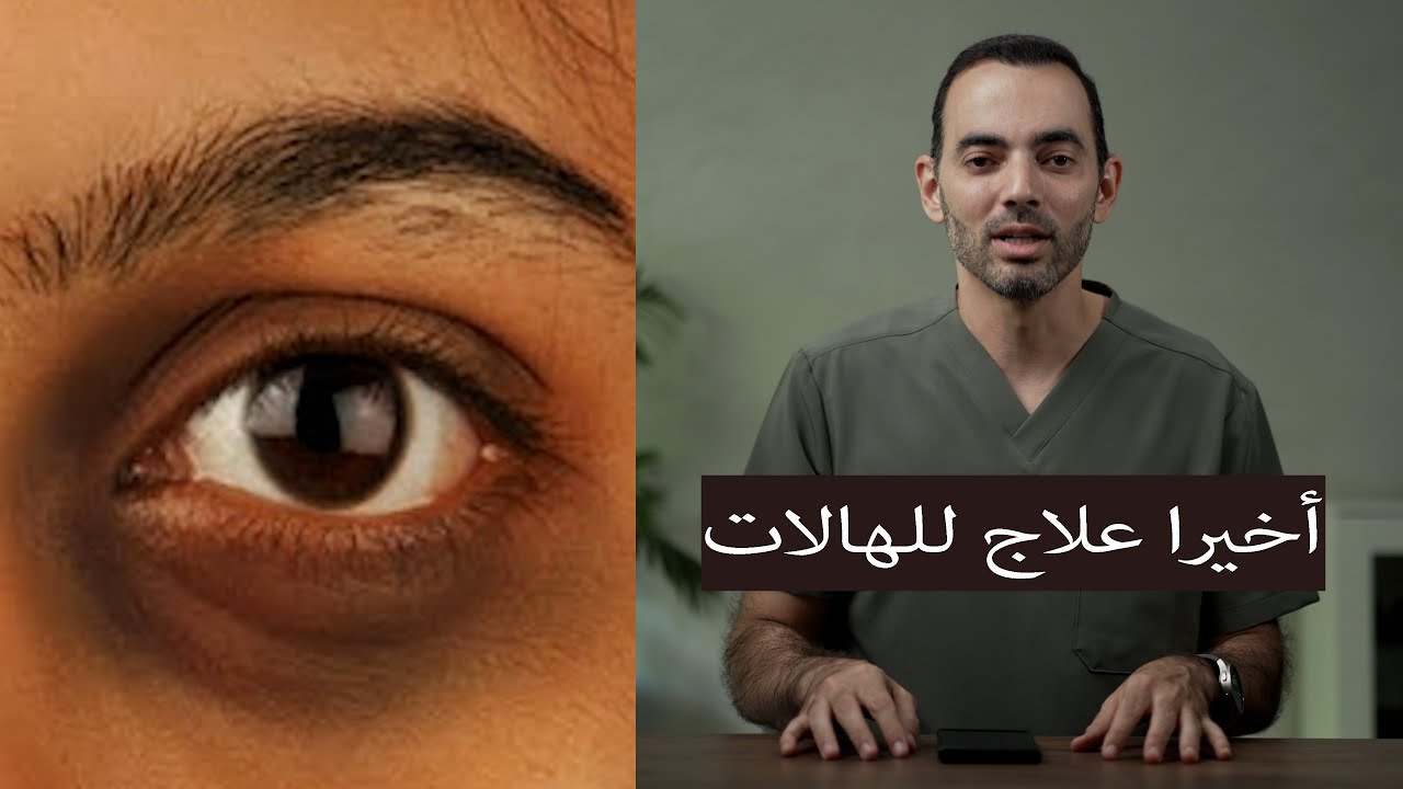 علاج جديد للهالات