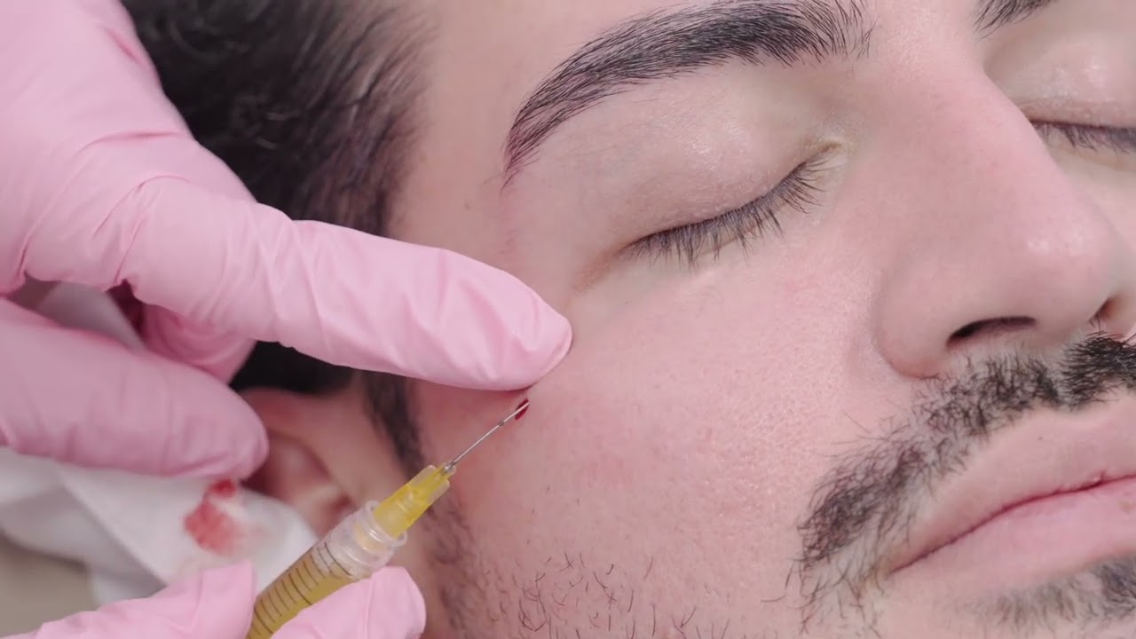 T-Lab® PRF Protocol | Under-eyes