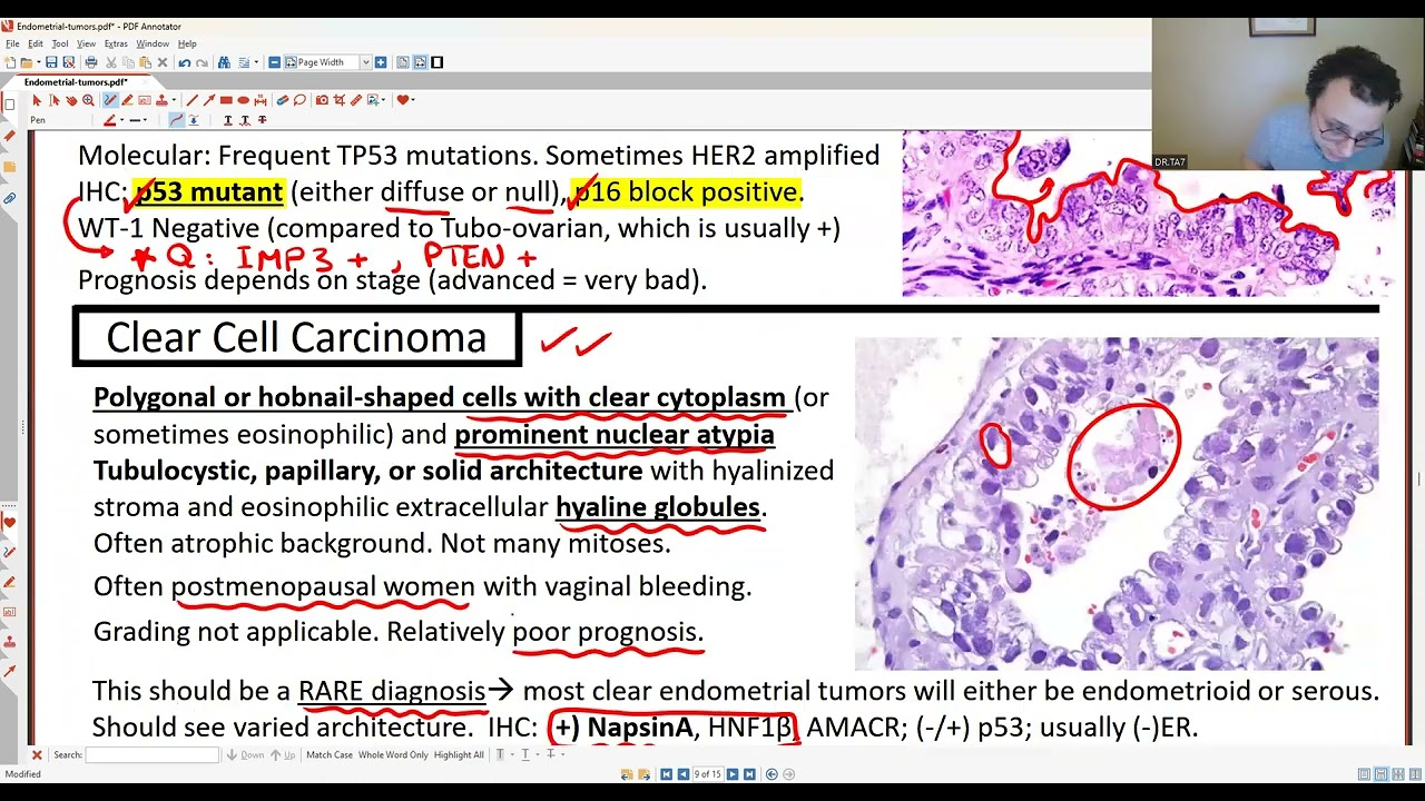 GYN PATHOLOGY: ENDOMETRIAL TUMORS 2