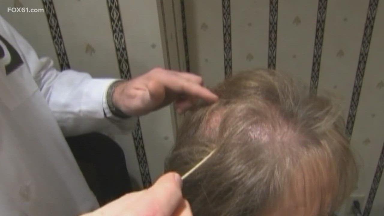 Alopecia hair loss treatments in testing stages: Yale Dermatologist