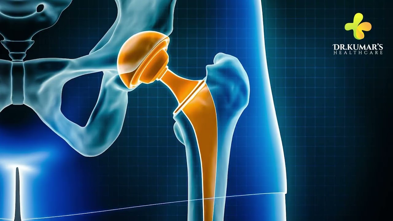 Hip Surgery at Dr. Kumars Healthcare | Advanced Orthopedic Care