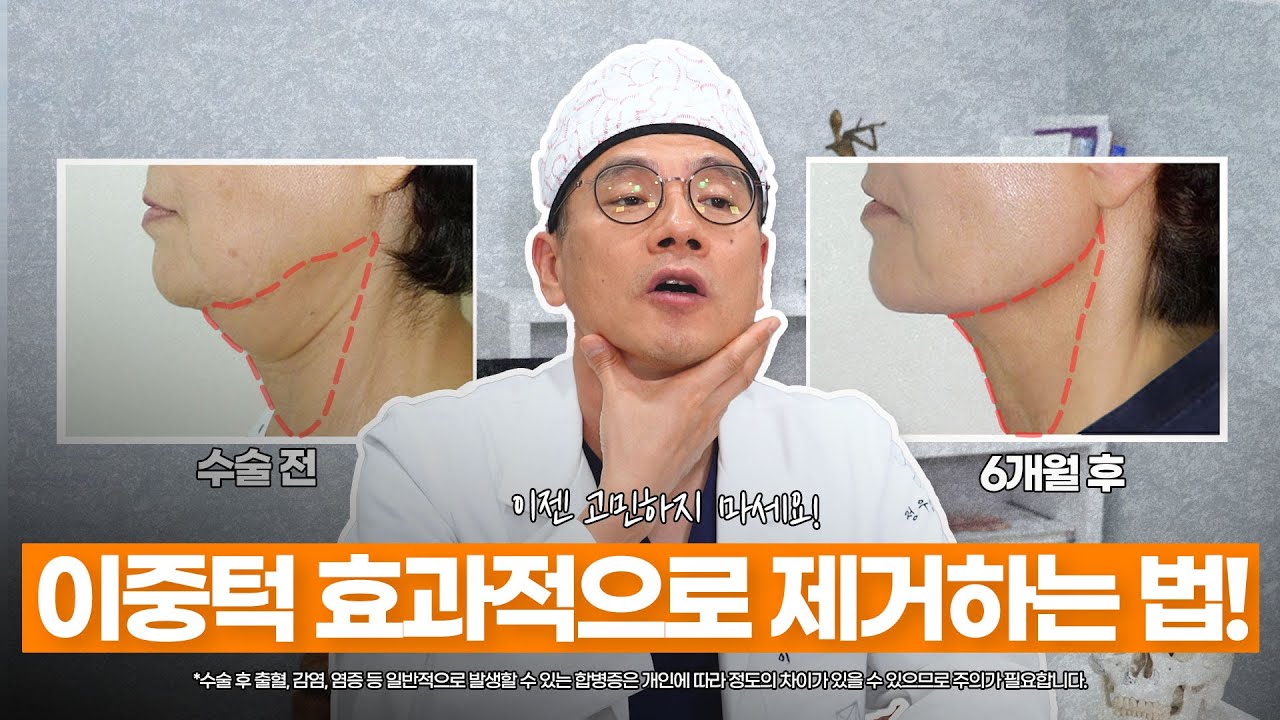 이중턱 지방을 가장 효과적으로 제거하는 방법을 알려드립니다!!