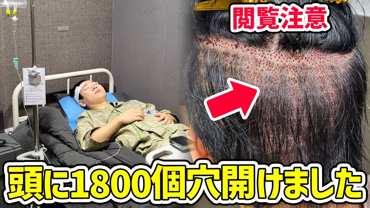 【衝撃映像】韓国で150万円の自毛植毛手術したら大変なことになりました