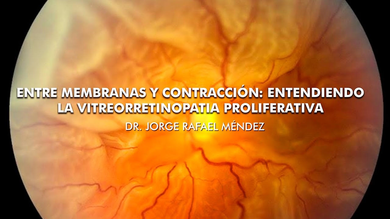 Entre membranas y contracción: Entendiendo la vitreorretinopatía proliferativa - Dr. Rafael Méndez