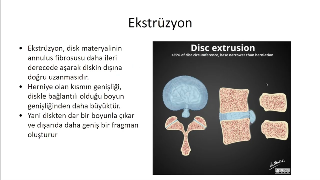 Lomber-Spinal Görüntüleme Yorumlama