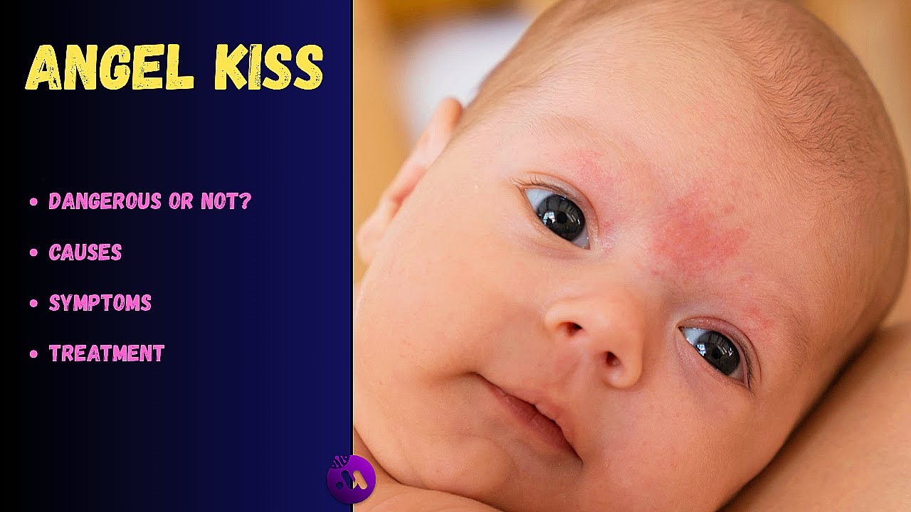 Will it fade? Angel&rsquo;s Kiss Birthmark in Babies