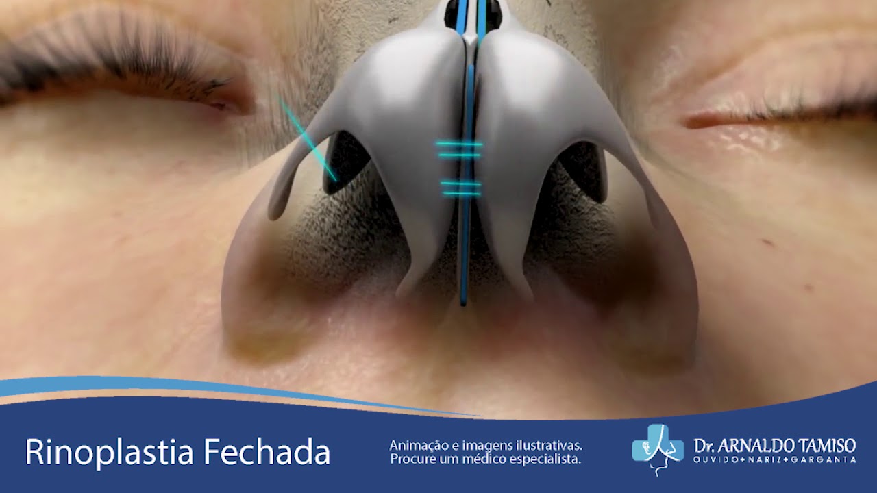RInoplastia Fechada - Dr. Arnaldo Tamiso