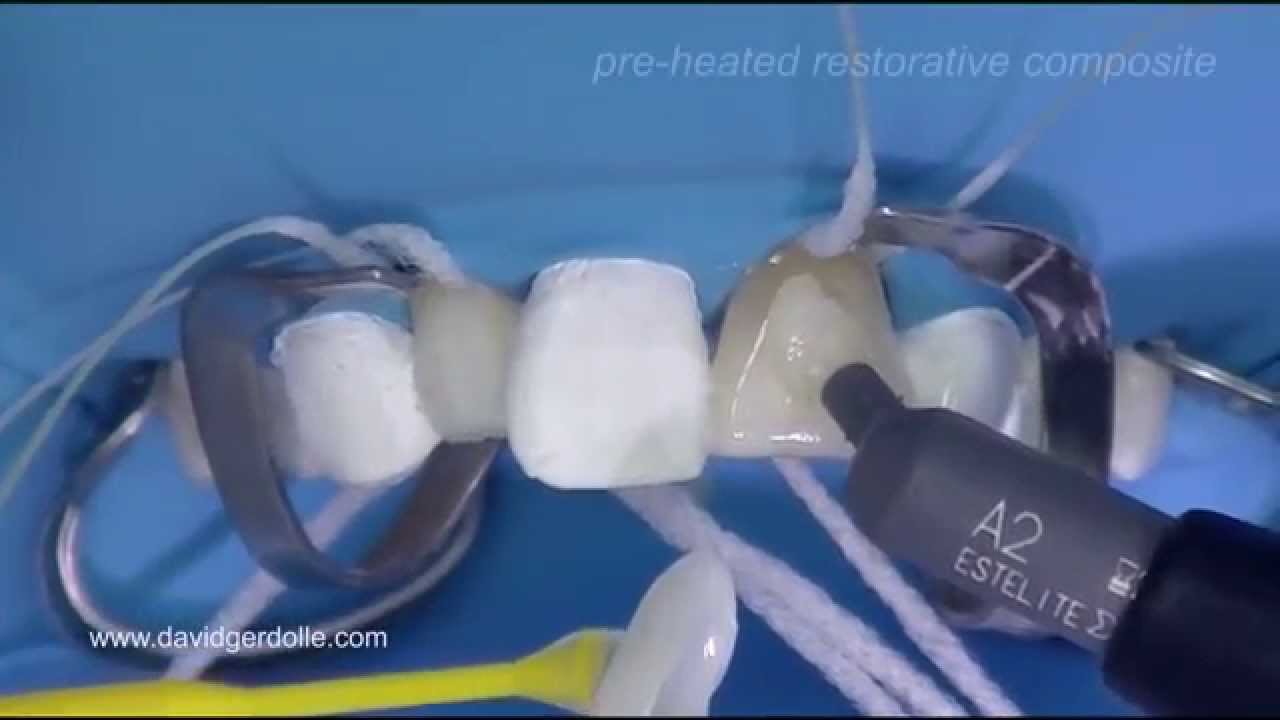Veneer cementation