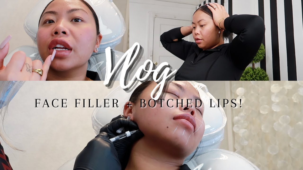 VLOG | GETTING CHIN & JAW FILLERS FOR A SLIM FACE + BOTCHED LIPS + WIX WEBSITE IS TERRIBLE! | NESSA