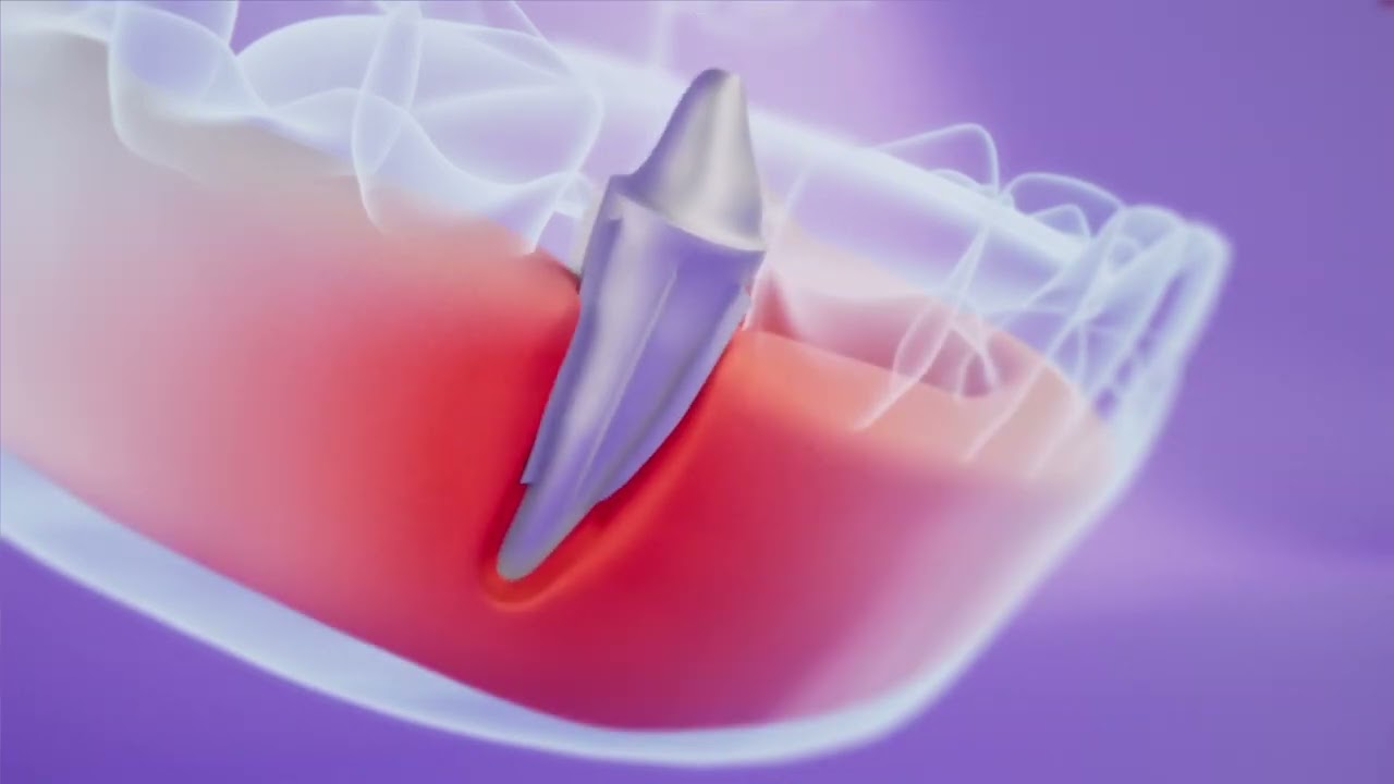 BiteOn dental implant explainer