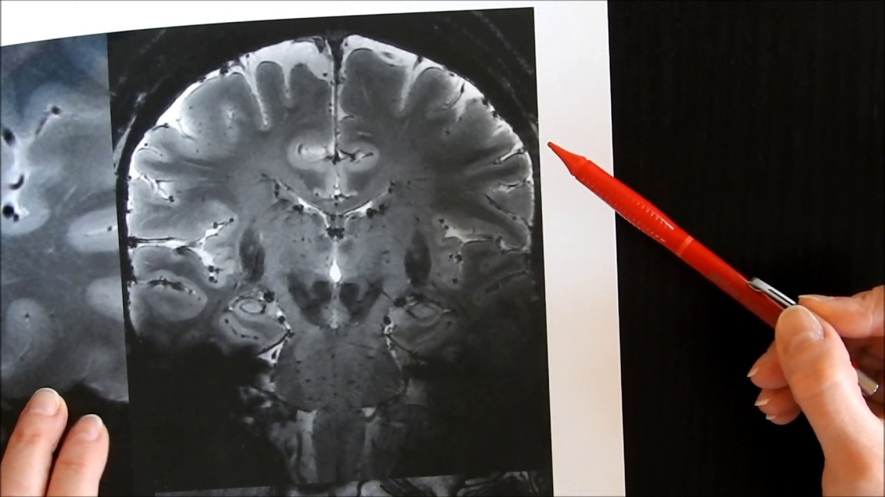 Limbisches System_Teil 2_Hirnmodell meets MRT