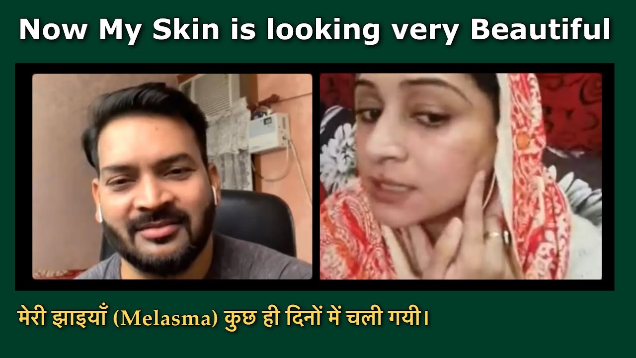 My face is looking so beautiful now. 80% Melasma/Pigmentation (झाइयाँ) has gone completely.
