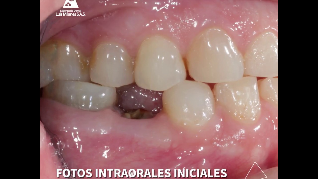 Caso de éxito Zirconio MultiLayer Kuraray A1 - Laboratorio Dental Luis Milanes SAS