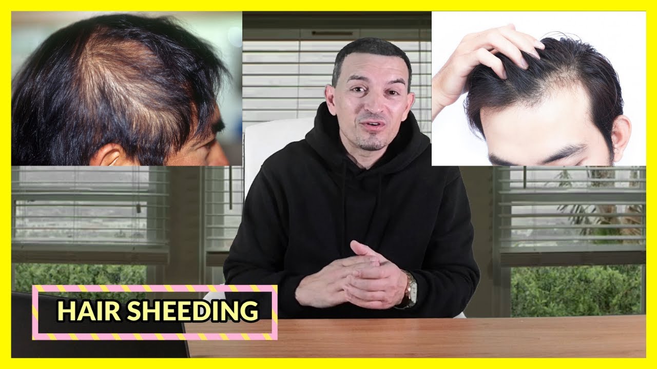 TIPOS DE CAÍDA DE CABELLO, TEMPORAL, ALOPECIA Y OTRAS CAUSAS