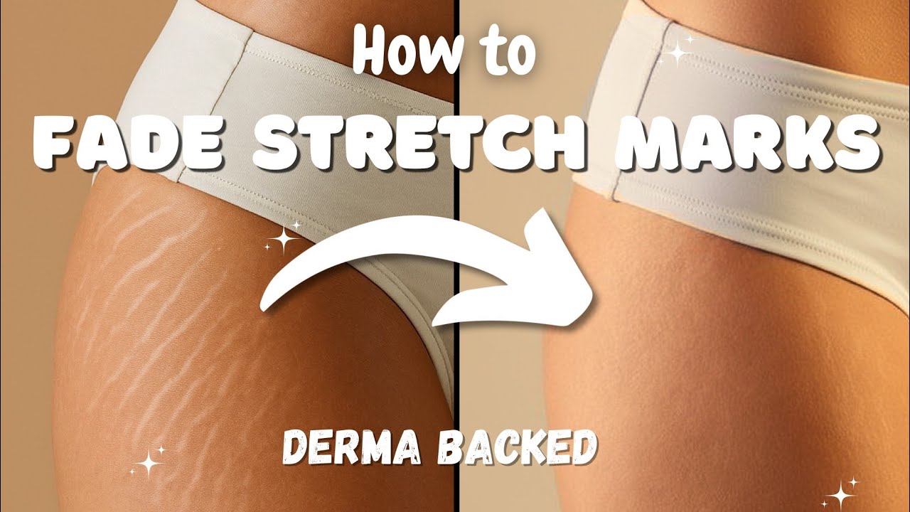 Как ДЕЙСТВИТЕЛЬНО уменьшить растяжки в домашних условиях || Derma Backed 🌷