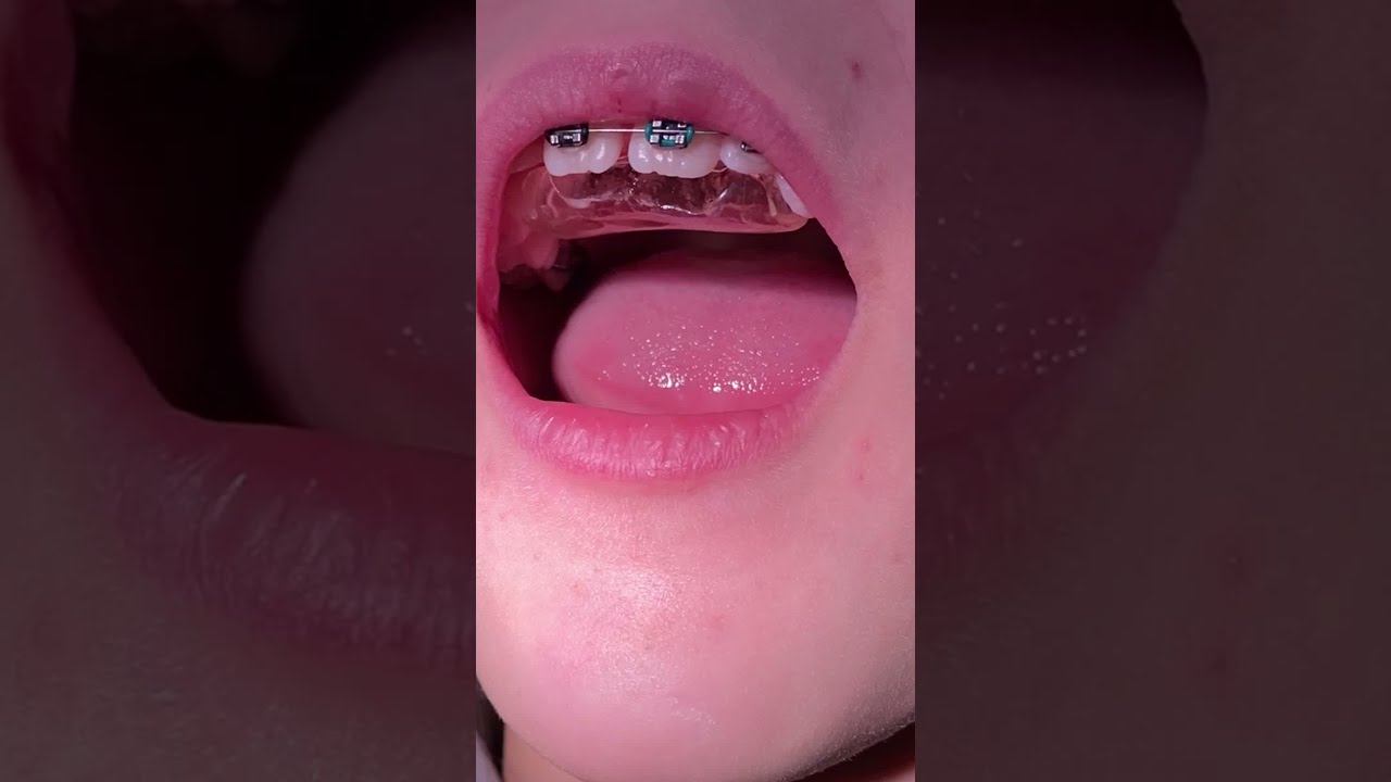 Orthodontic  Bite Plate Broken - Tooth Time Family Dentistry New Braunfels Texas