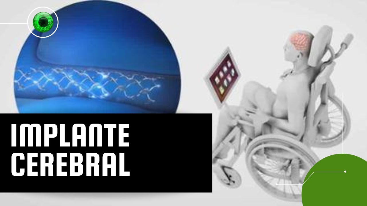 Chip implantado no cérebro é capaz de 