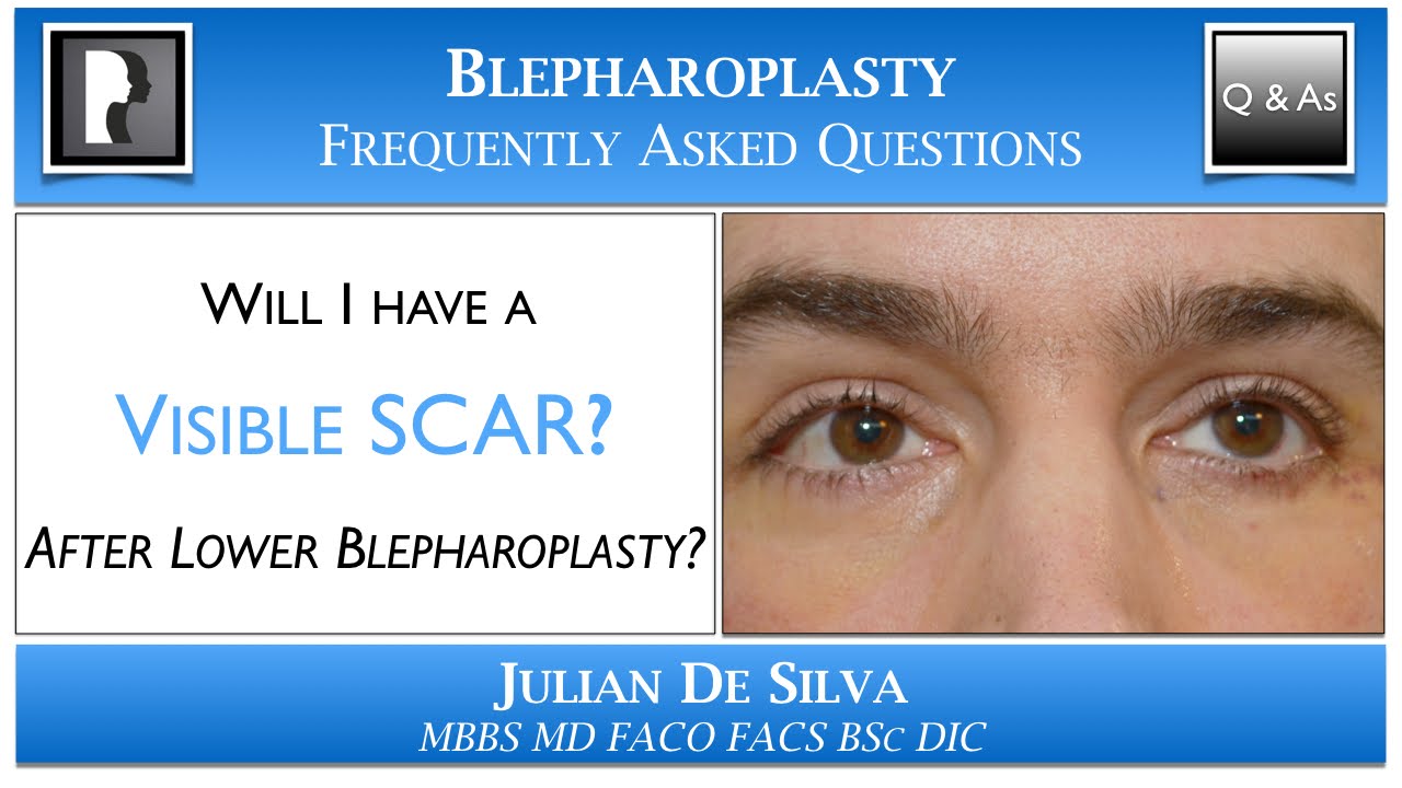 Will I have a Visible Scar after Lower Blepharoplasty? Scar after an lower eyelid lift?
