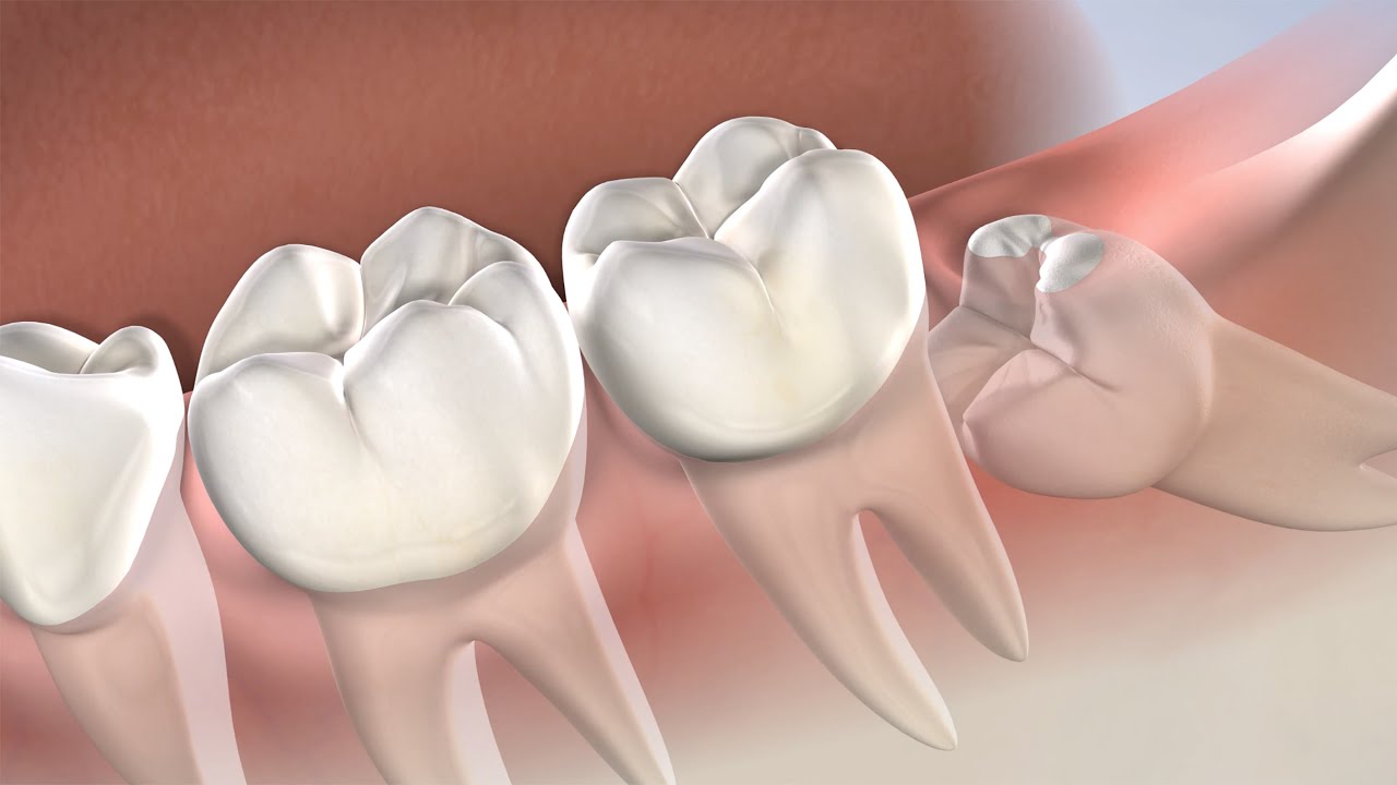 Wisdom Teeth Removal with Dr. Seghi at Oral Surgery & Dental Implant Specialists of Cincinnati