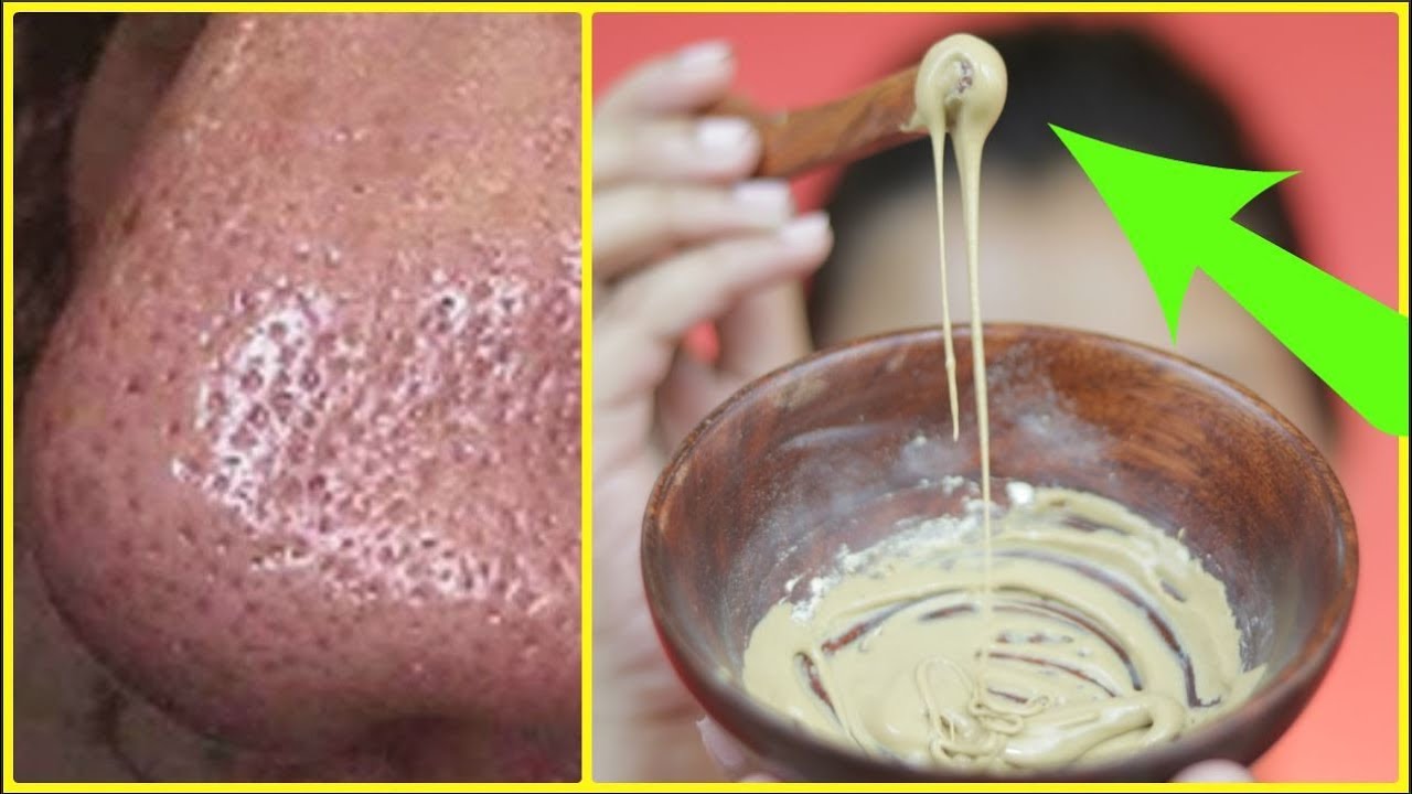 Try this to vanish OPEN PORES within 10 MINUTES/INDIANGIRLCHANNEL TRISHA