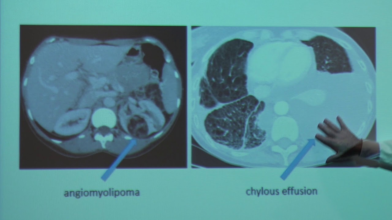 LAM Action Patients' Meeting 2018 - Rapamycin and LAM