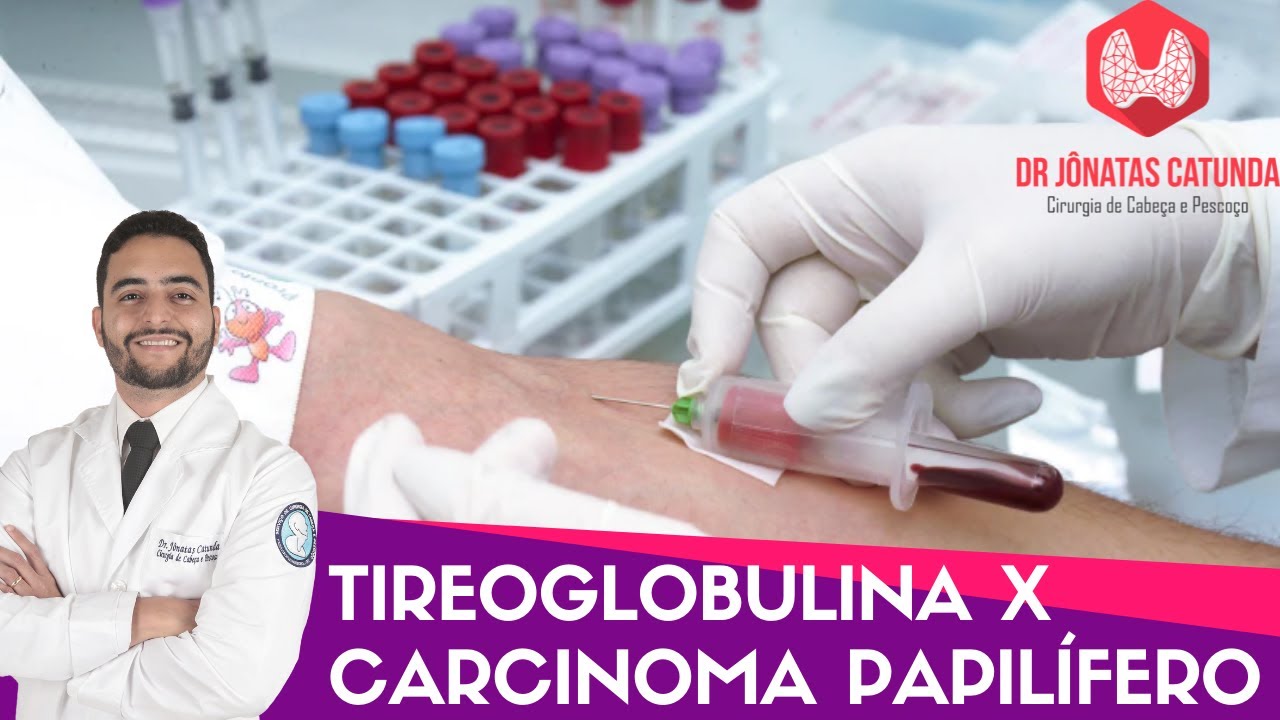 Tireoglobulina X Carcinoma papilífero