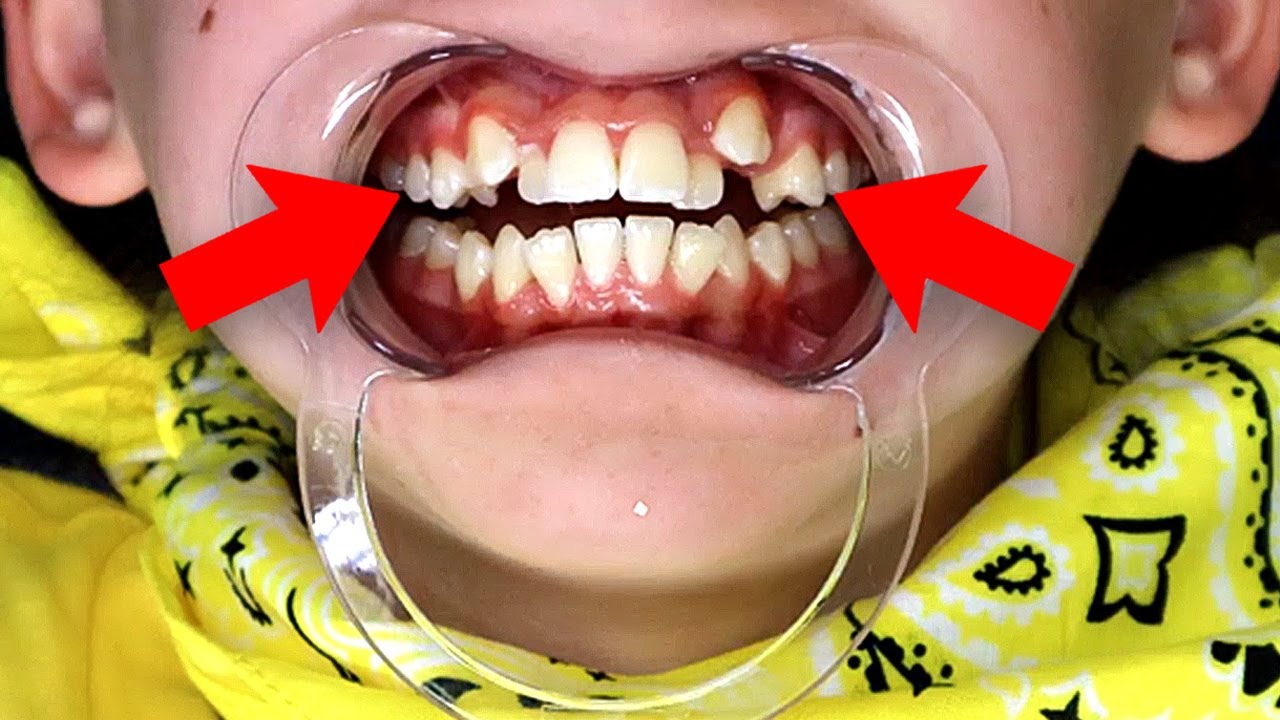 Teeth Crowding: When to Consider Extractions