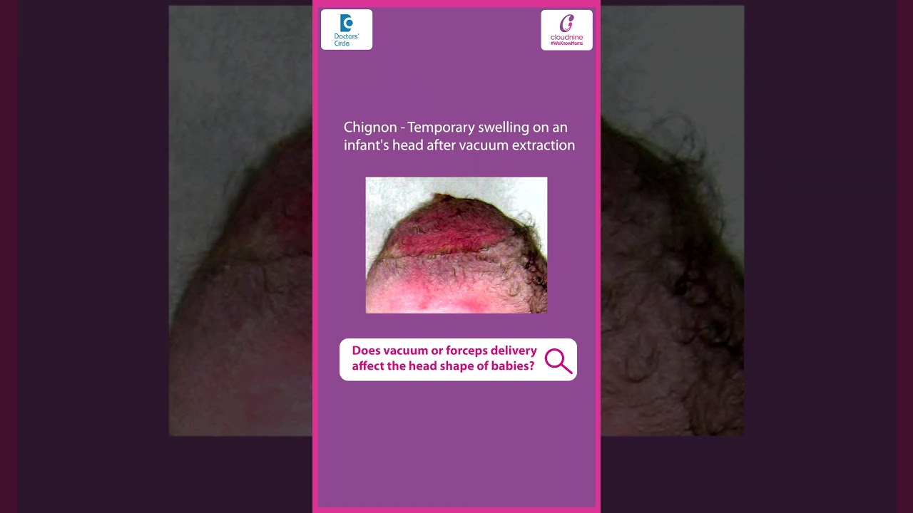 BABY HEAD SHAPE | Does Vacuum or #forceps Delivery affect head shape of #baby - Dr. Ashmina Khalsa