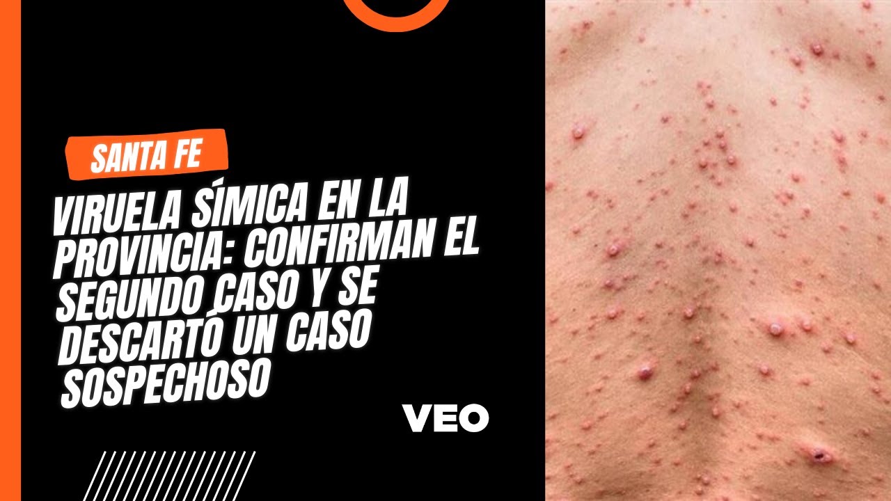 Viruela s&iacute;mica en la Provincia: confirman el segundo caso y se descart&oacute; un caso sospechoso