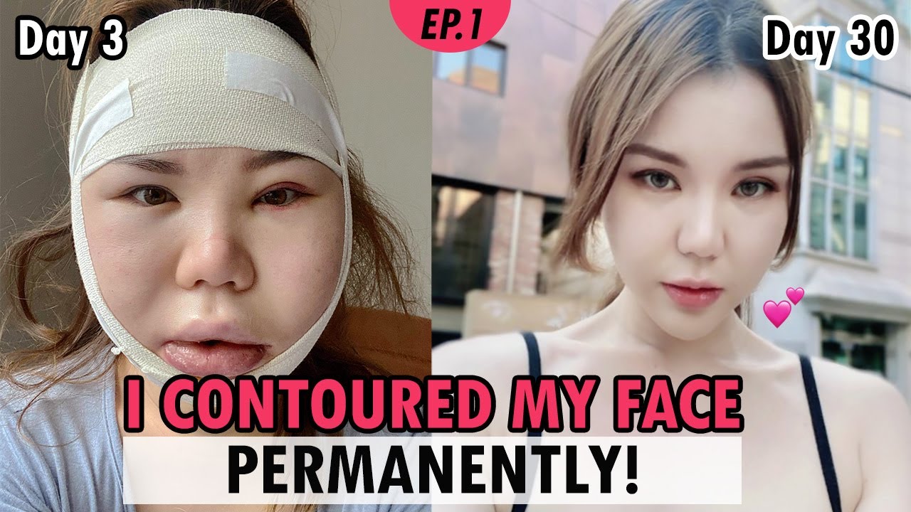 [SUB] Zygoma & Jawline Reduction in Korea | vline facial bone surgery vlog review | Recovery Results