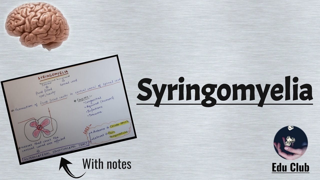 Syringomyelia | CNS Physiology