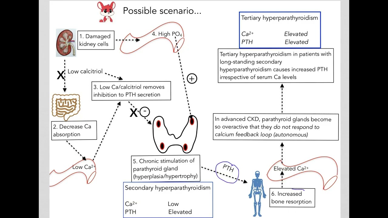 9.10 Hypercalcemia  from causes other than primary hyperparathyroidism and cancer