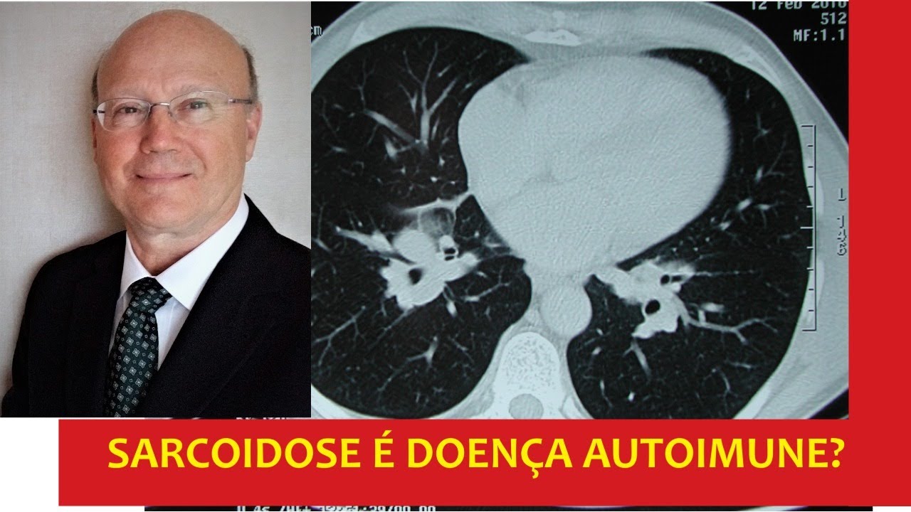 Uma moderna compreensão da sarcoidose: as queixas dos pacientes e as dificuldades de diagnóstico