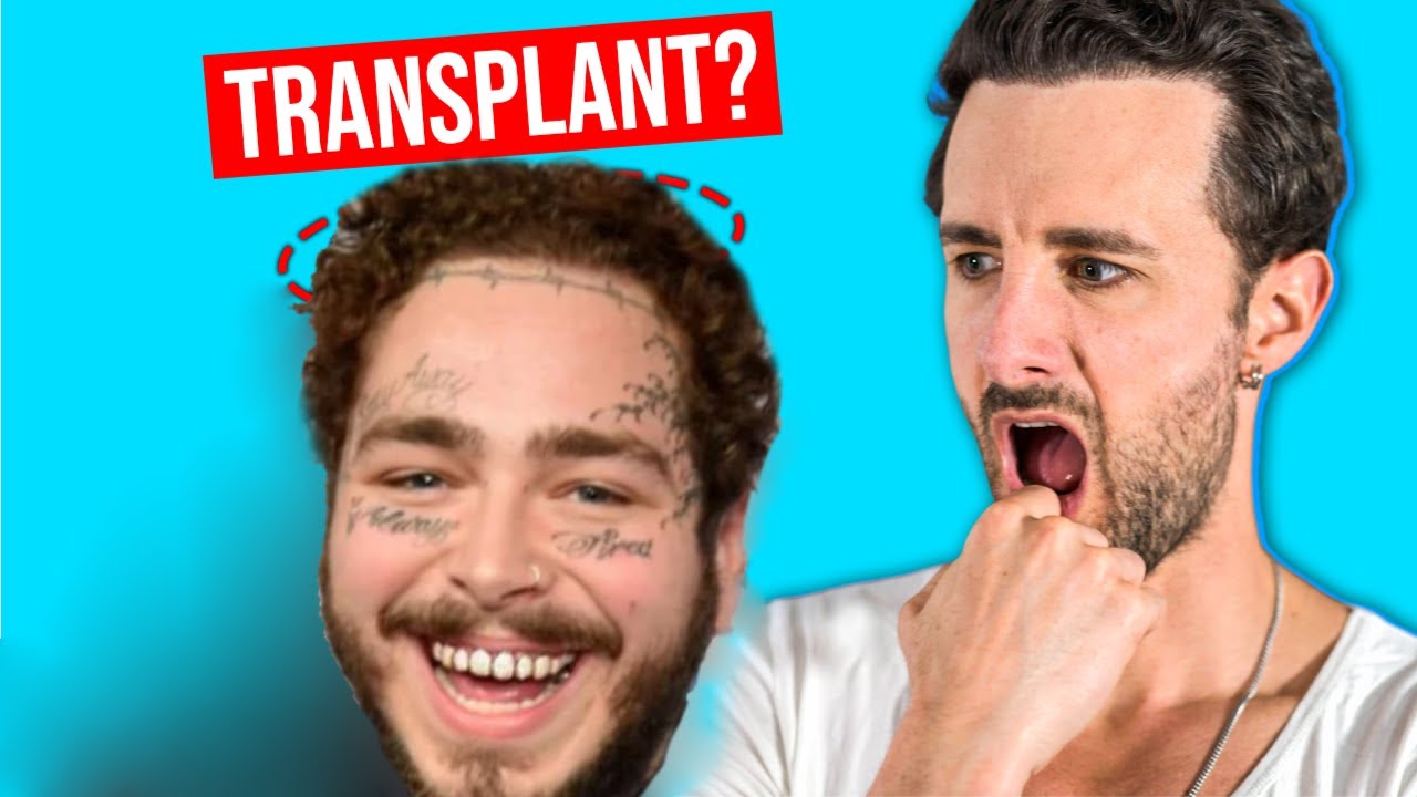Post Malone Hair Transplant Surgery? Logic too?