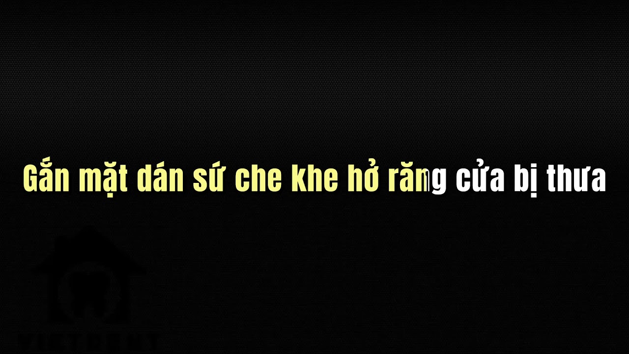 Mặt d&aacute;n sứ che khe răng cửa thưa
