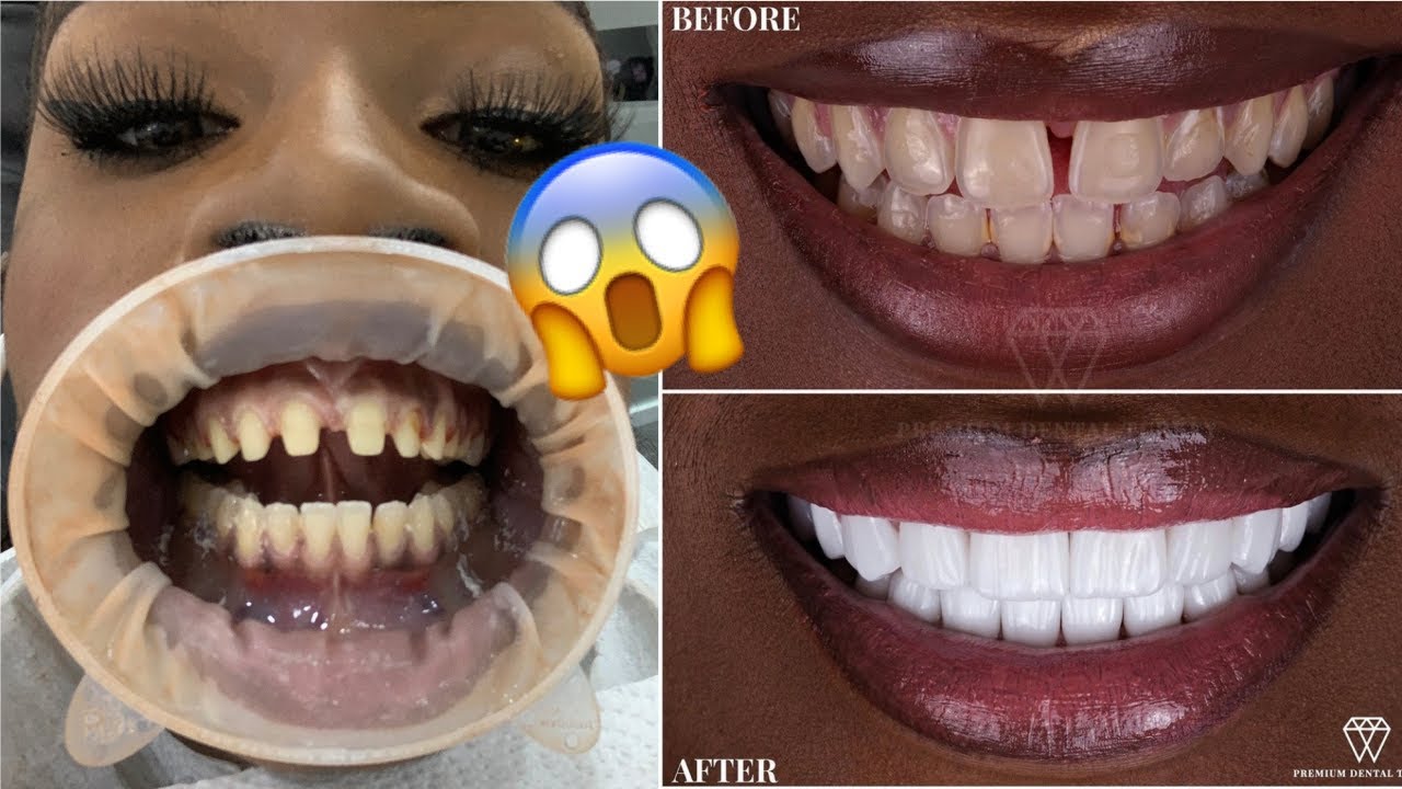 GETTING MY VENEERS DONE IN TURKEY! 🇹🇷 *NO HORSE TEETH* | TRAVEL VLOG