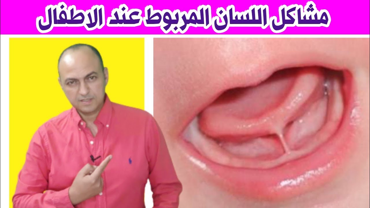 كيفية معرفة اذا كان لسان طفلك مربوط ام لا ( tie tongue ) ما هى مضاعفات اللسان المربوط و كيفية علاجه