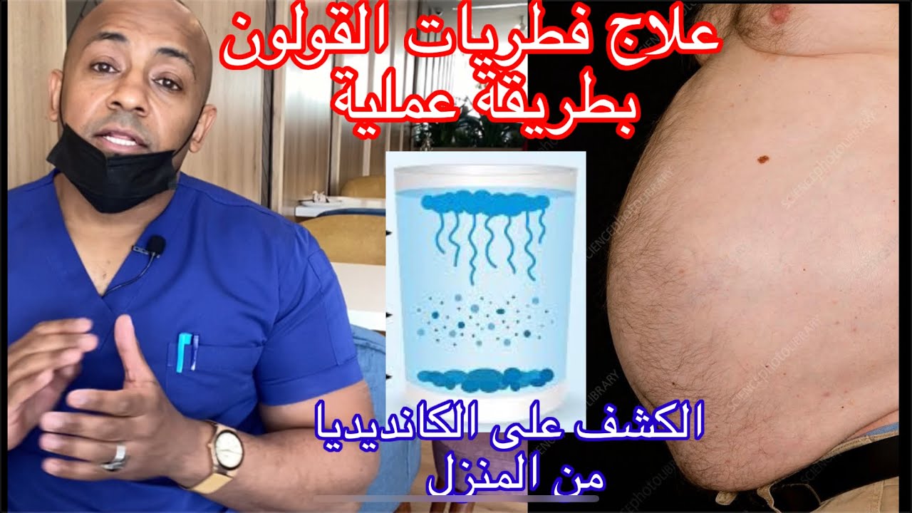 ٢- تطهير الجسم من الفطريات و الكانديديا  بطريقة عملية  خطوة بخطوة