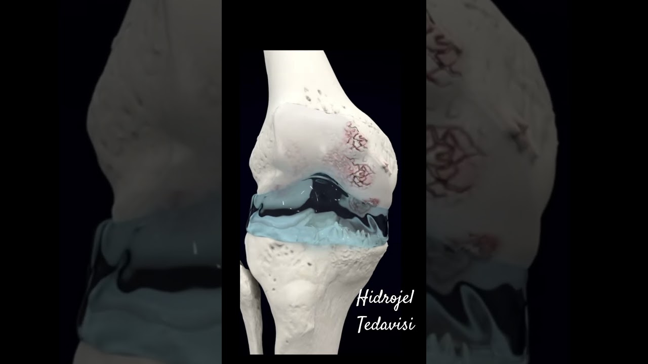 #dizağrısı Hidrojel tedavisi