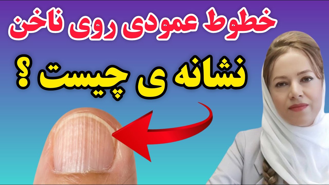 خطوط عمودی  روی ناخن:هشدار برای کسانی که خطوط عمودی روی ناخن دارند علت و درمان خطوط ناخن