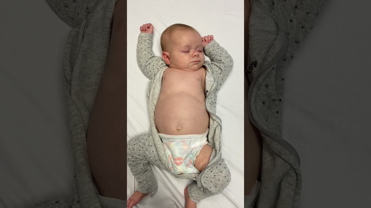 Baby with Bronchiolitis showing signs of increased work of breathing.