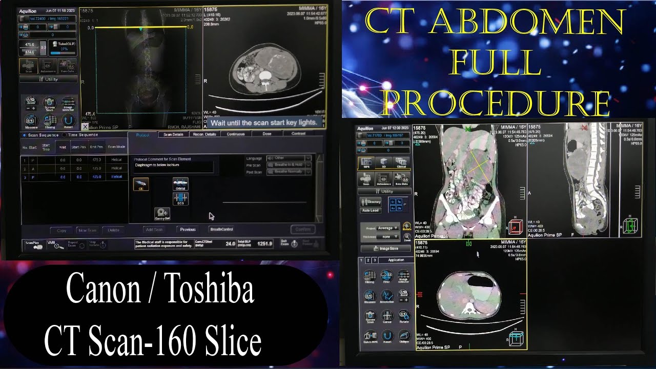 CT Scan of Abdomen Full Procedure #basicradiology