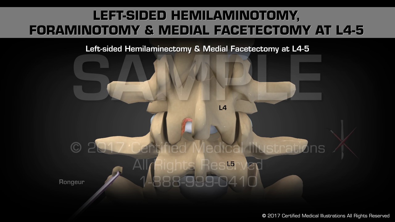 Left-sided Hemilaminotomy, Foraminotomy & Medial Facetectomy at L4-5