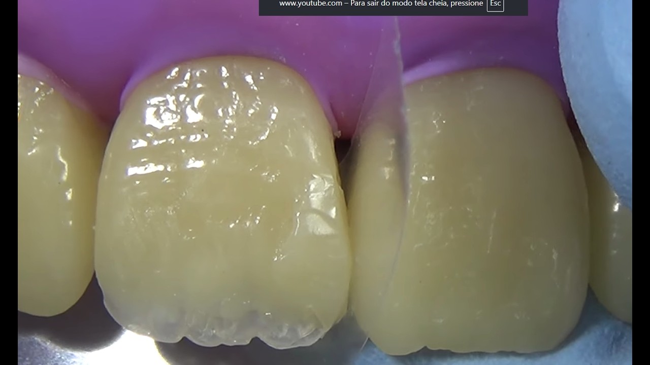 O Segredo da Restauração Invisível em Dente Quebrado (Análise)