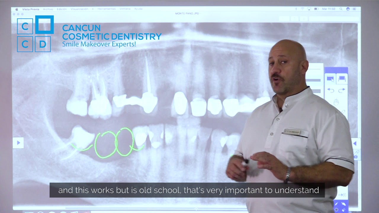 😷 The Dental Specialists in Mexico 😷If you have lost most of your teeth YOU NEED TO WATCH THIS!👀